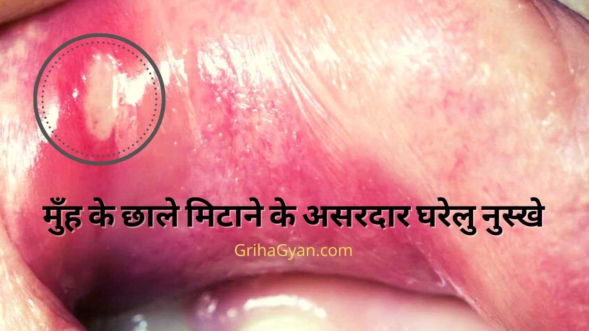 मुँह के छाले मिटाने के असरदार घरेलु नुस्खे (Mouth Ulcer Home Remedies In Hindi)