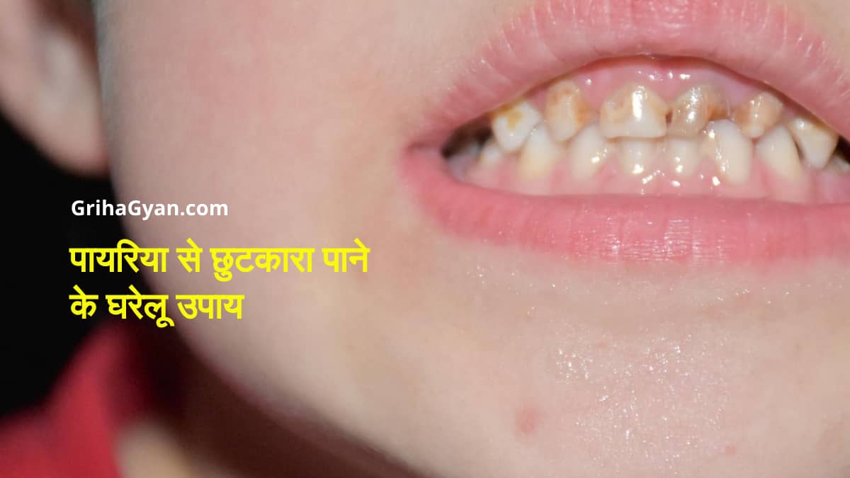 पायरिया से छुटकारा पाने के घरेलू उपाय (Pyria Home Remedies in Hindi)